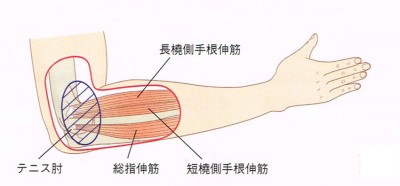 テニス肘