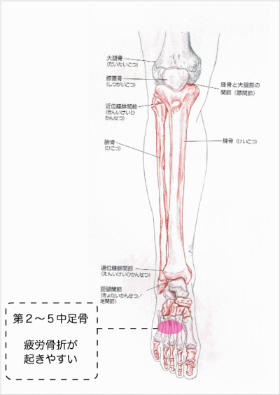 疲労骨折2
