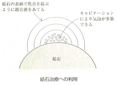 結石